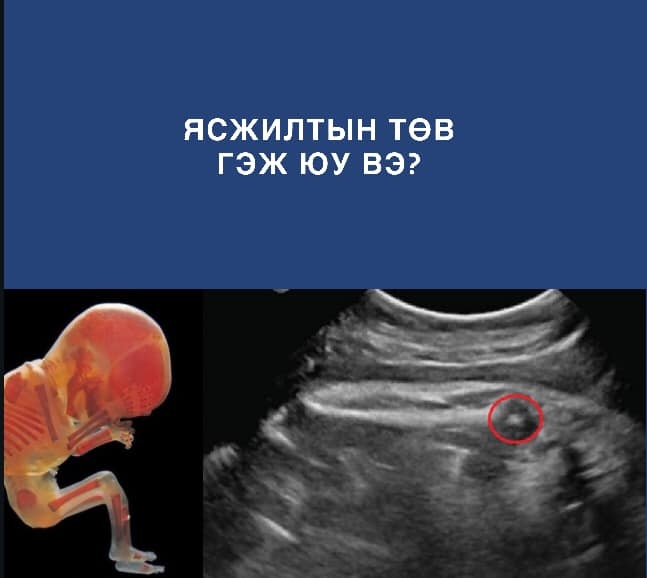 ЯСЖИЛТЫН ТӨВ ГЭЖ ЮУ ВЭ? /Нийслэлийн Өргөө амаржих газрын Ахлах зэрэгтэй Эх барих эмэгтэйчүүдийн эмч М.Түвшинжаргал/