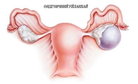 “ӨНДГӨВЧНИЙ УЙЛАНХАЙ" ГЭЖ ЮУ ВЭ?