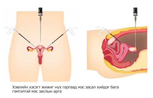 ЭМЭГТЭЙЧҮҮДИЙН ДУРАНГИЙН МЭС ЗАСАЛ